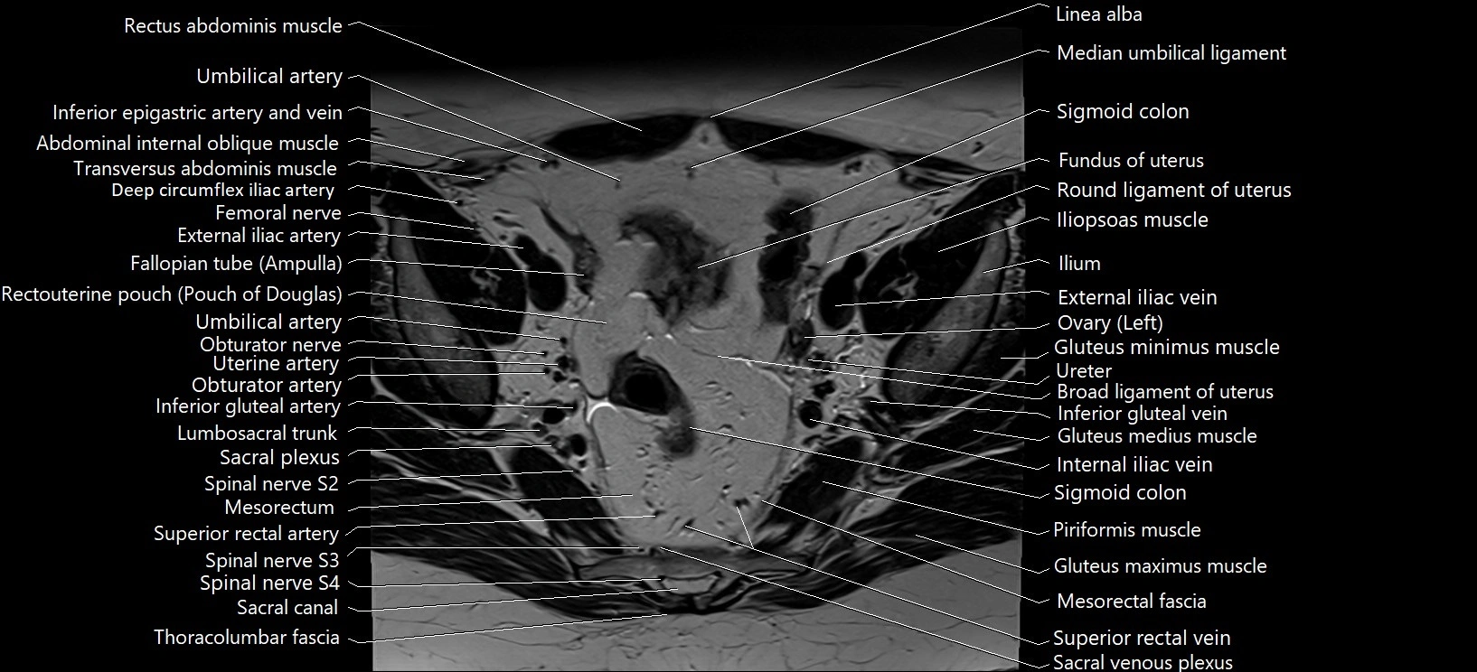 Axial cross sectional anatomy of female pelvis (MRI 3T) image 12.webp